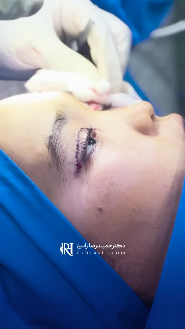 جراحی زیبایی پلک یا بلفارو پلاستی 😍