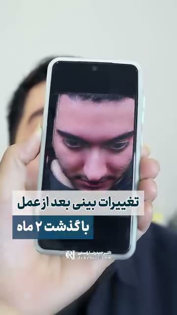 👩🏻‍💻جهت اطلاع از هزینه عمل عدد ۸ رو کامنت کن 😍