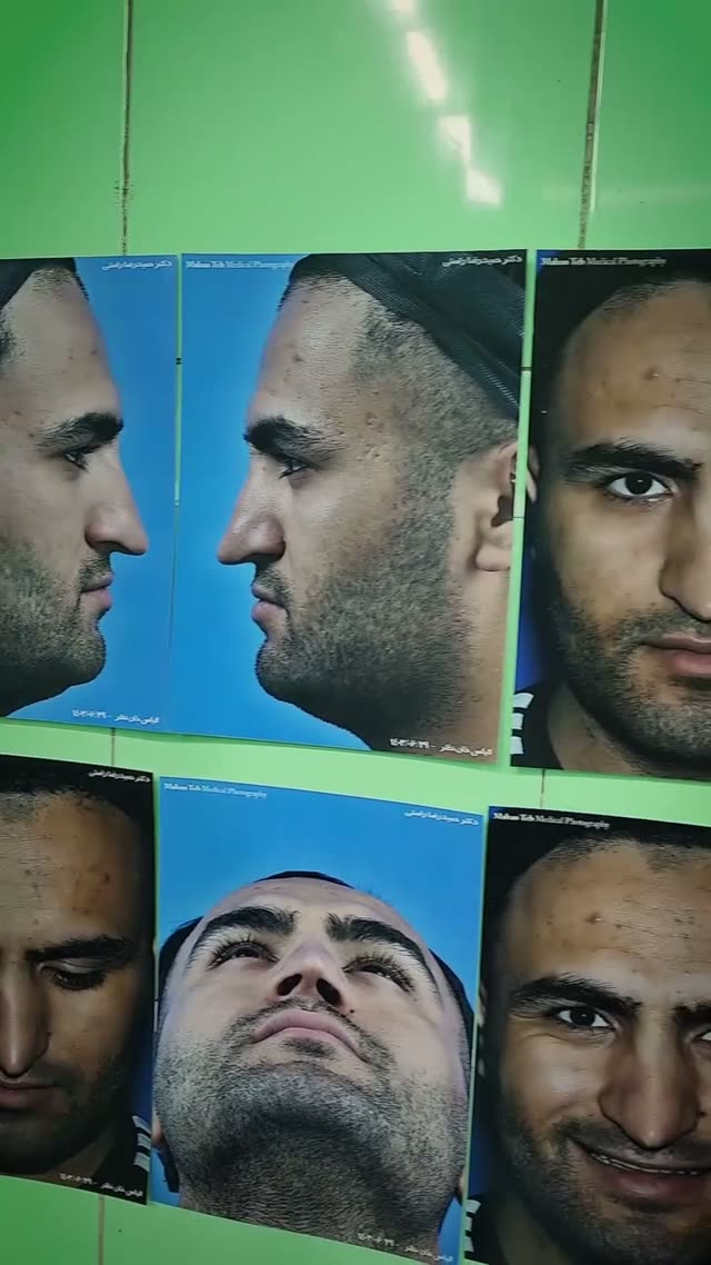 دوست عزیزمون که سابقه دو عمل ناموفق در خارج از کشور رو‌داشتند ، مرحله سوم پیش ما اومدن و…