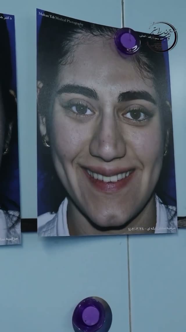 از اتاق عمل تا برداشتن آتل جراحی زیبایی بینی گوشتی 😍