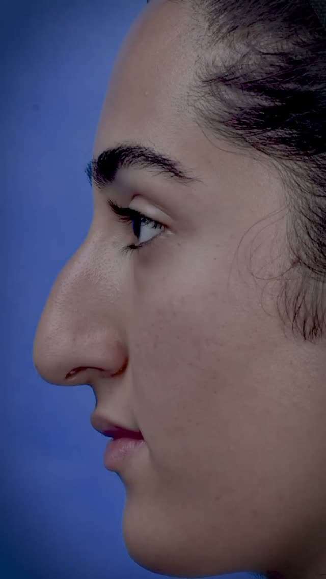 بینی گوشتی بعد از یک ماه از جراحی زیبایی بینی👌
