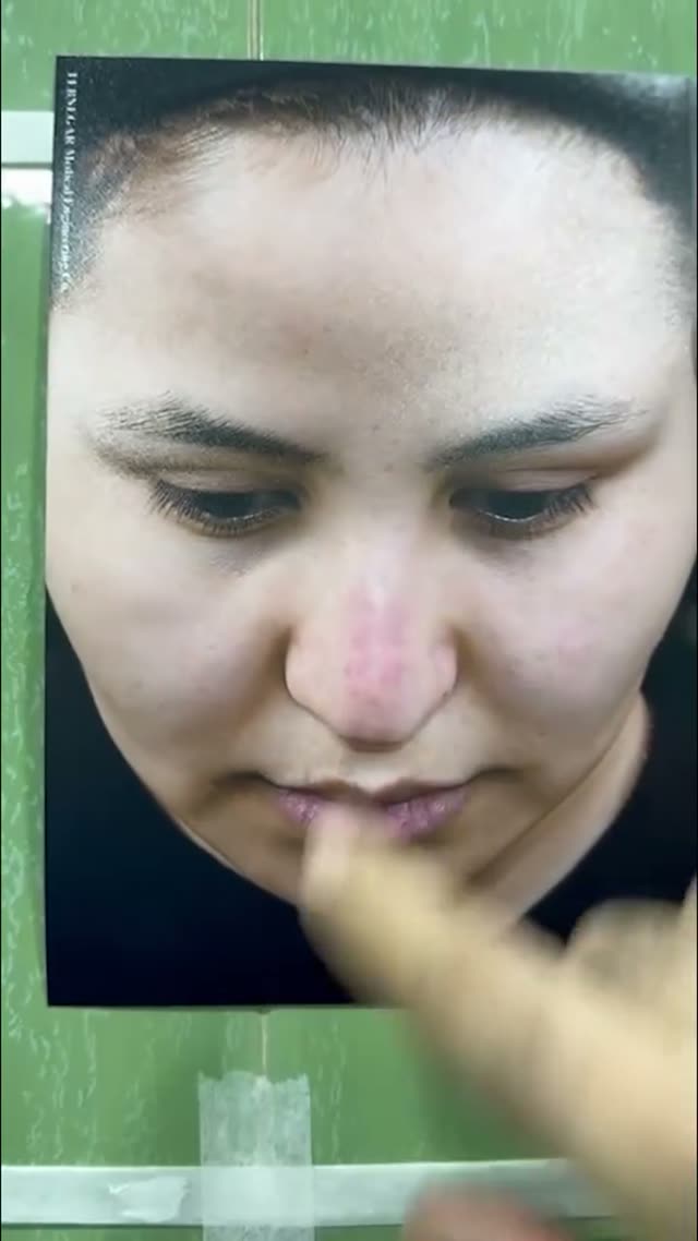 تخلیه فیلر بینی در قسمت هامپ بینی