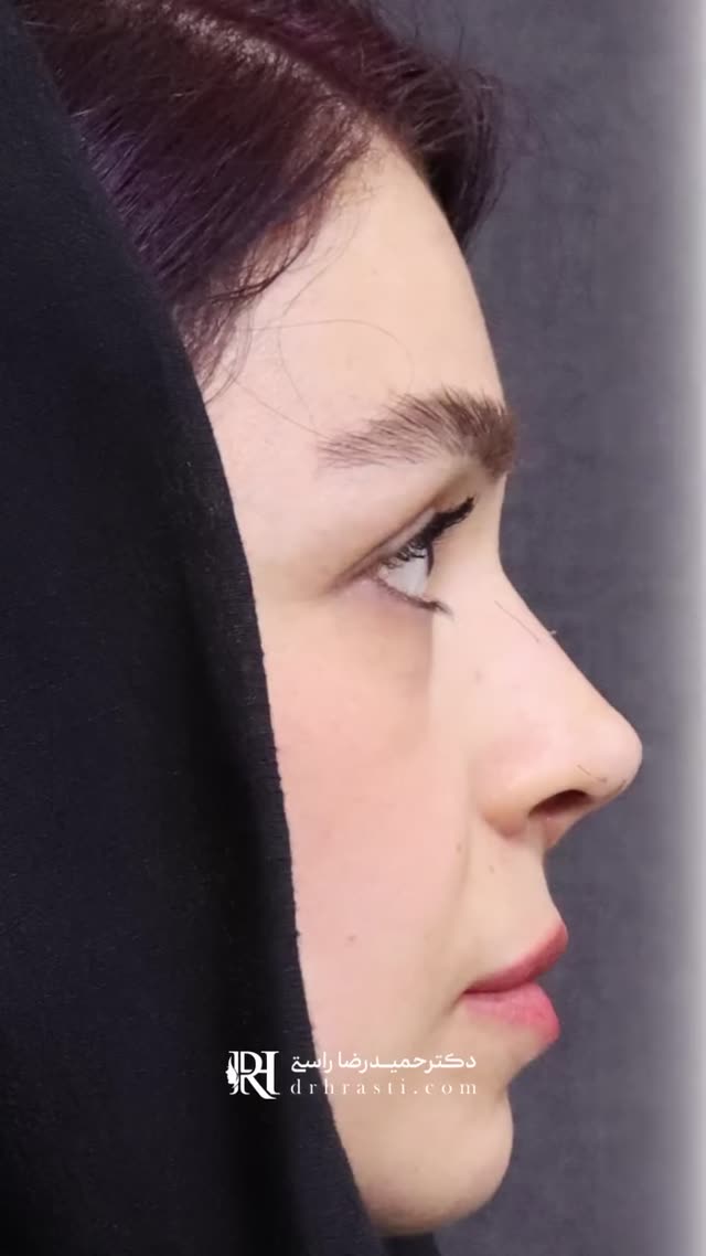 👃🏻✨ فقط یه هفته از عمل بینی گذشته و نتیجه‌ها فوق‌العاده‌ست