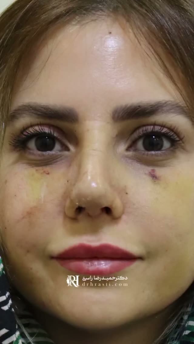 یک هفته بعد از عمل دختر زیبامون 😍🩵