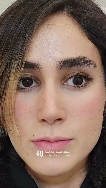 “یک سال از عمل بینی من گذشت