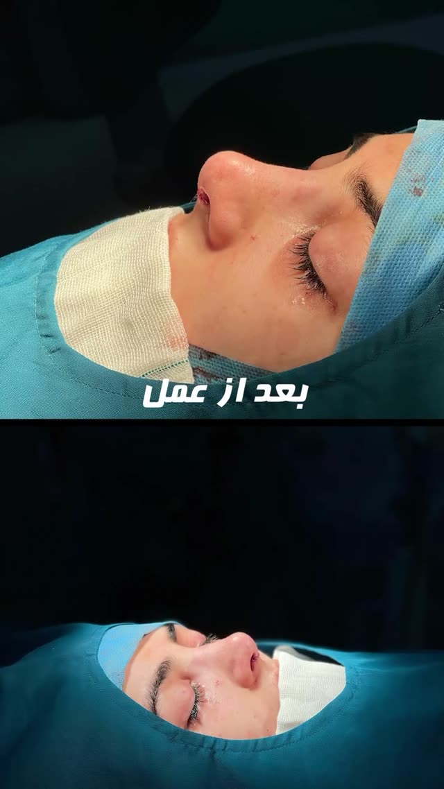 از قبل تا یکسال بعد از جراحی بینی✨