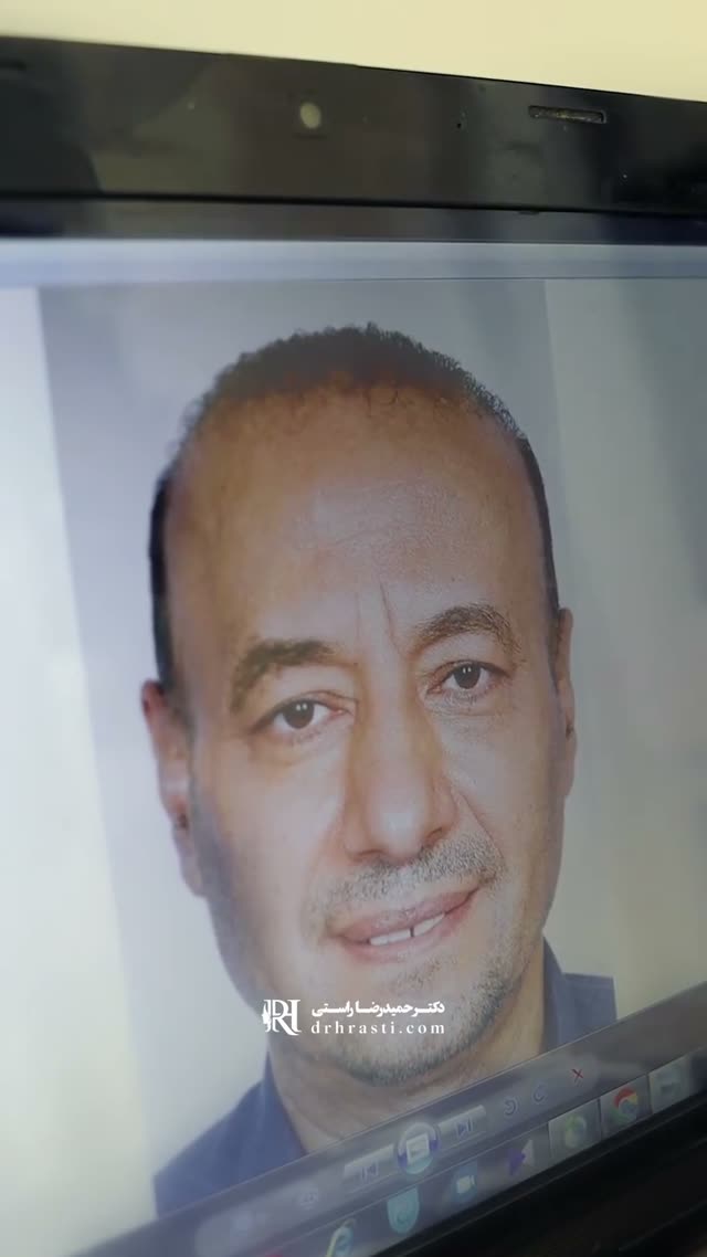 اگه نگرانی که میشه با سن بالای ۴۰ سال هم جراحی بینی انجام داد یا نه این کلیپ رو تا آخر بیین☺…