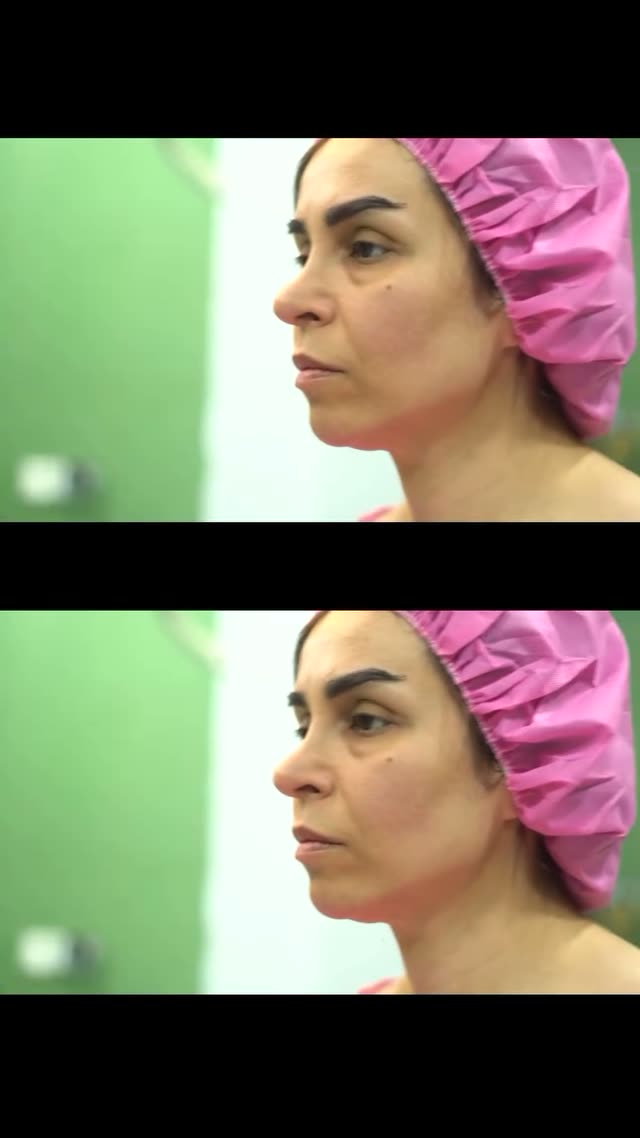 به همین دلیل گرفتن نتیجه مطلوب از عمل های ترمیمی هم سختتر هست🥰