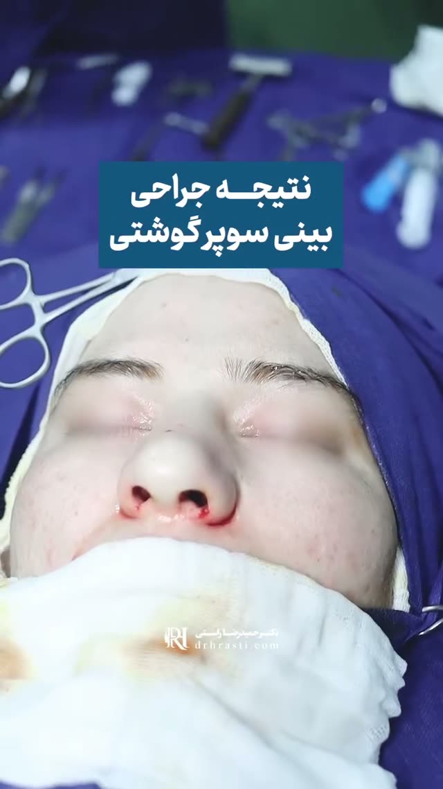 بینی گوشتی، نتیجه‌ای فراتر از انتظار
