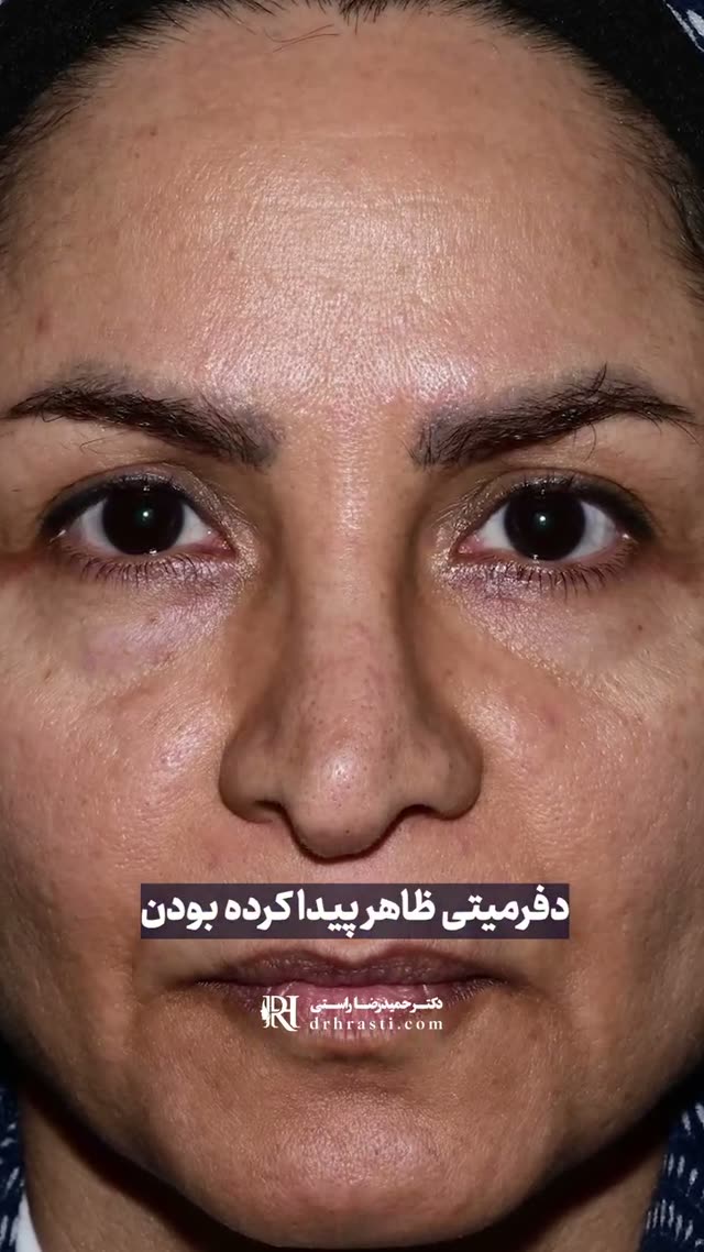 ترمیم دکتر حمیدرضا راستی با استفاده از تکنیک اختصاصی و پیزوسرجری باعث شد این بینی: