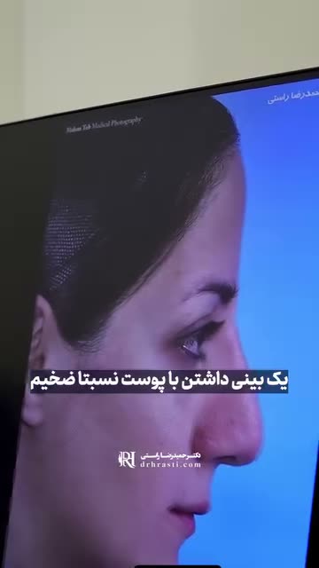 ✨ بینی گوشتی و تجربه‌ای متفاوت ✨