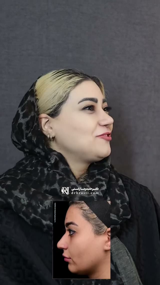 بعد از عمل بینی چی کار نکنیم