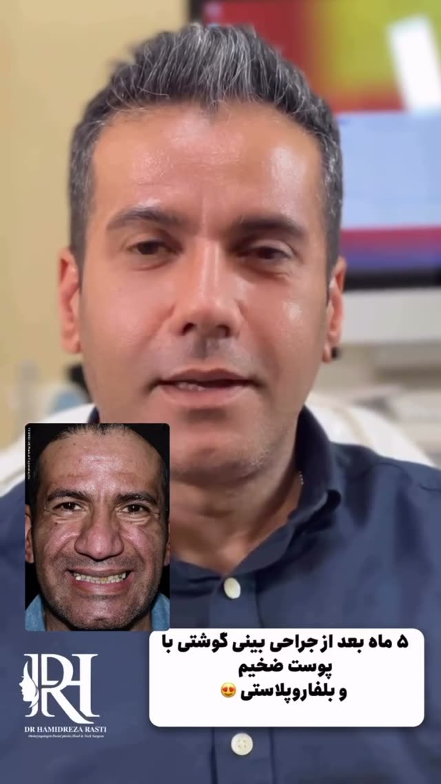 👃🏻 فقط ۵ ماه بعد از جراحی بینی گوشتی با پوست ضخیم