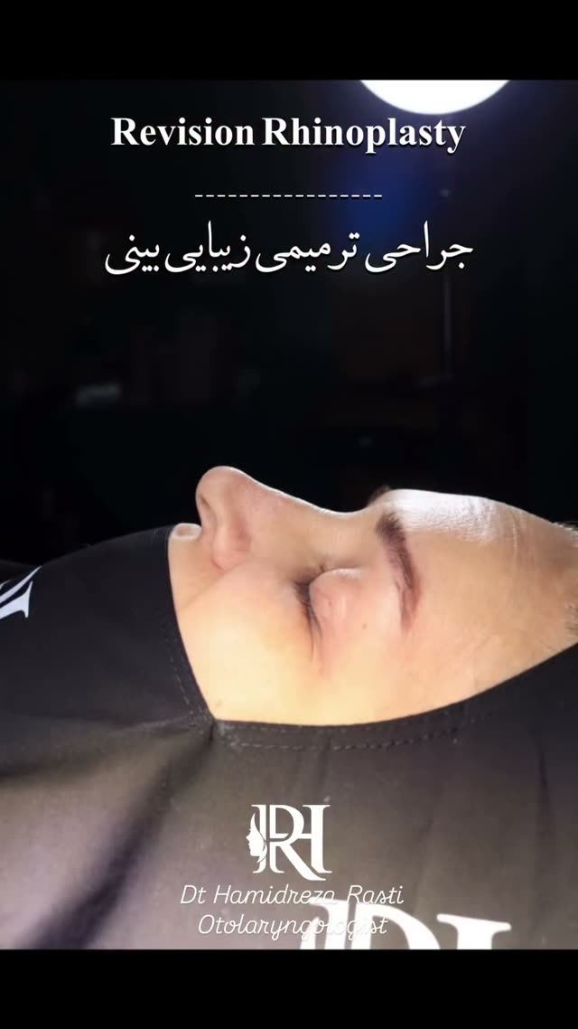 ✨ بازسازی زیبایی بینی شما با جراحی ترمیمی