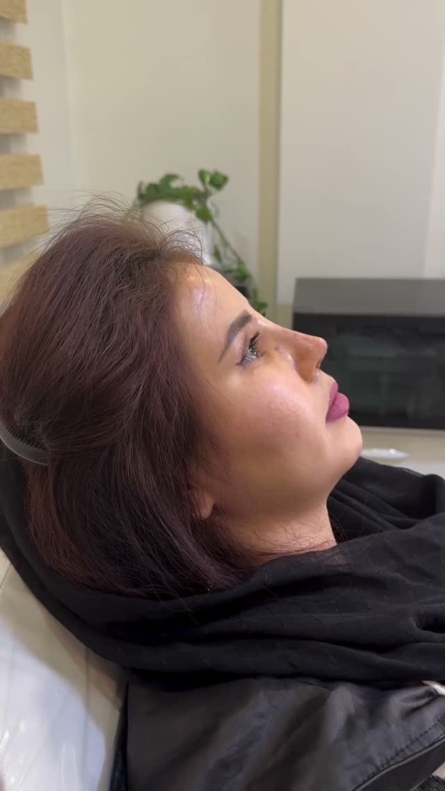 بلافاصله بعد از برداشتن آتل بینی ،جراحی بینی آسیایی با استفاده از برداشت غضروف دنده…
