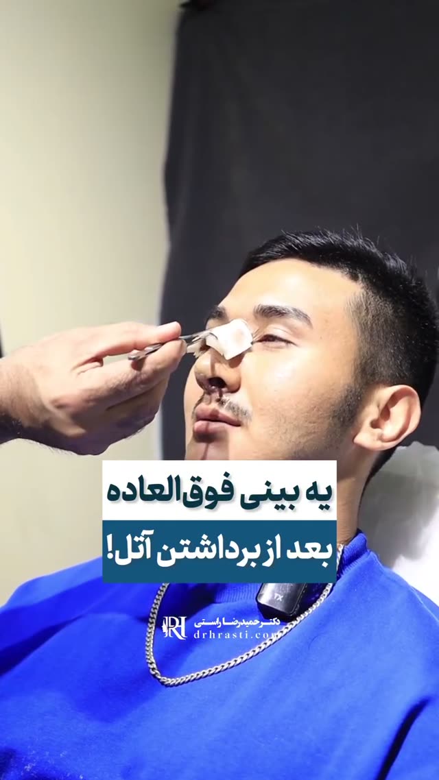 آتل و که برداشت، باورش نمی‌شد بینیش چقدر صاف و مردونه شده