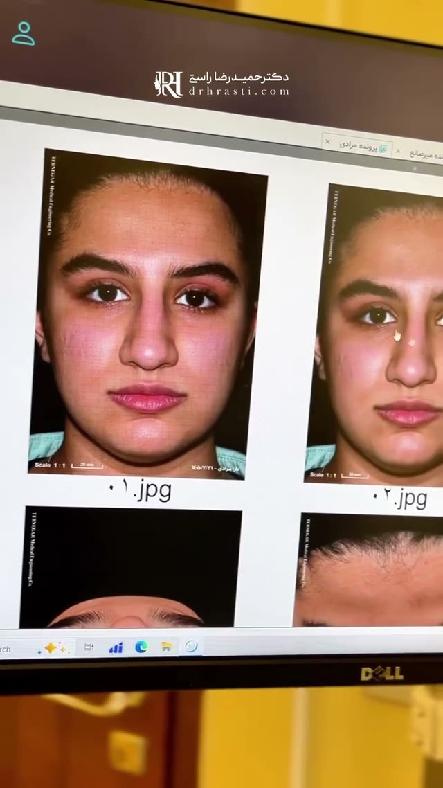 سه ماه بعد از جراحی بینی ✨