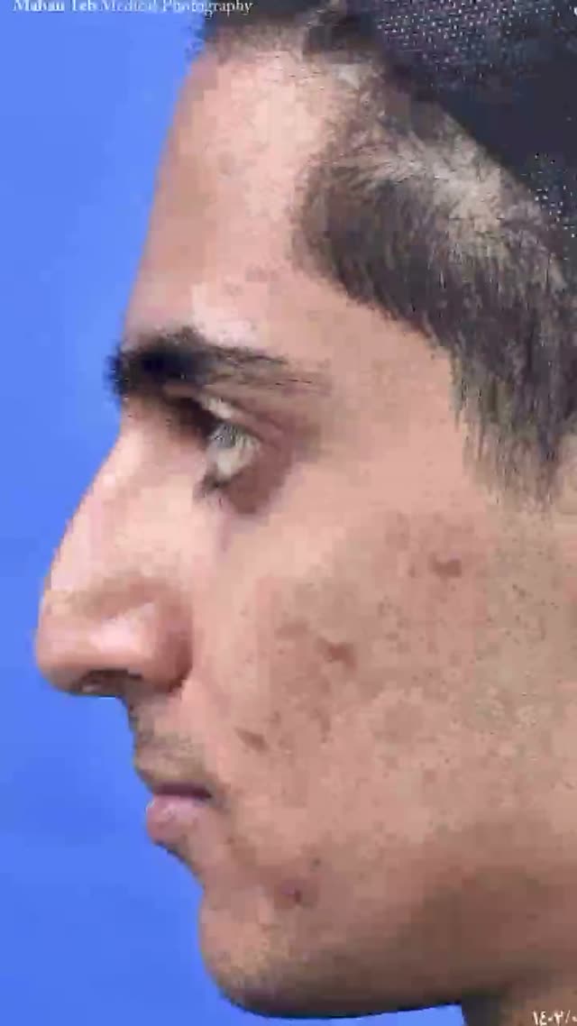 نچرال رینوپلاستی