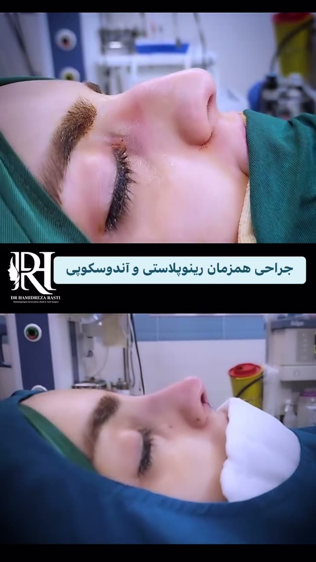جراحی همزمان زیبایی بینی و آندوسکوپی سینوس