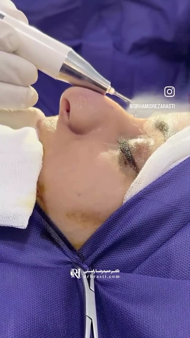 ✨ جراحی زیبایی بینی با دستگاه پیزوسرجری