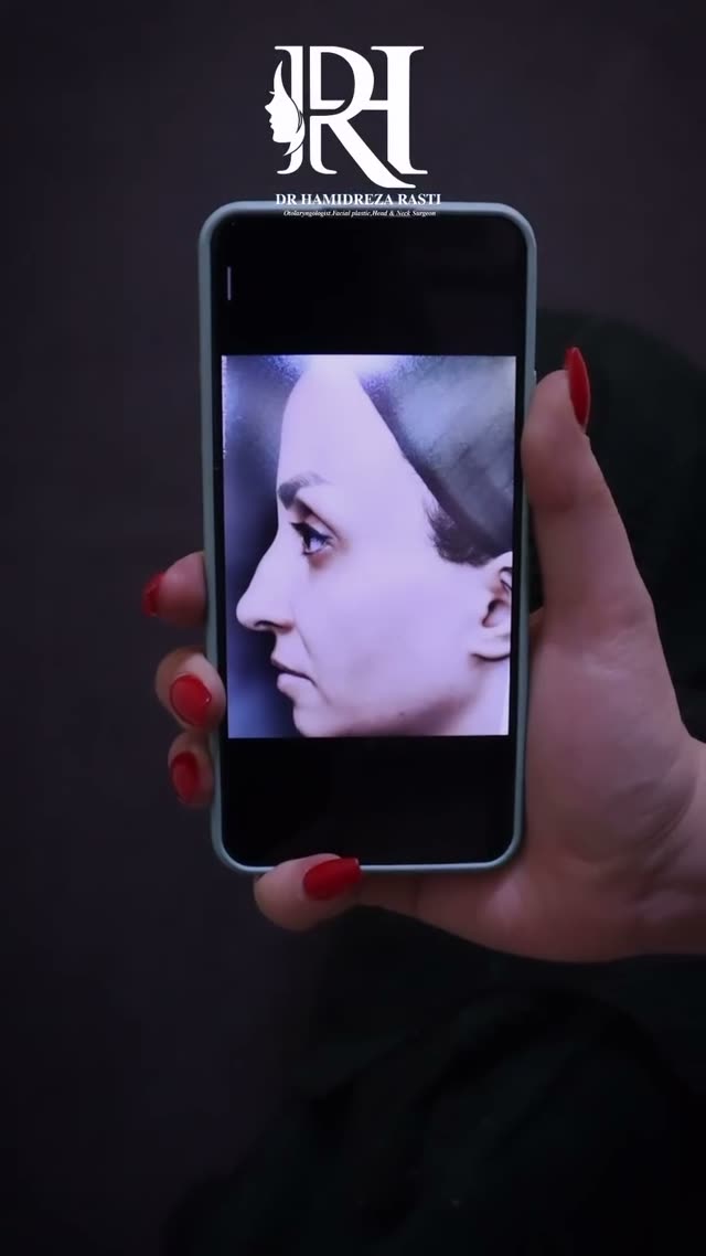 تنها یک ماه بعد از جراحی بینی با شکستگی قبلی به سبک طبیعی 🥰