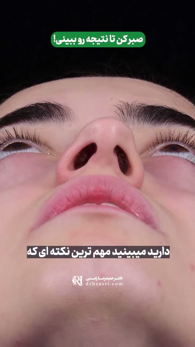 پریای عزیز با یه انحراف محور بینی، قوز و نوک کمی گوشتی اومد پیش دکتر راستی ✨