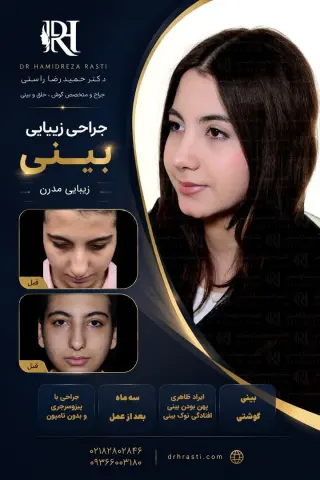 Real before-and-after result of Dr. Hamidreza Rasti's rhinoplasty