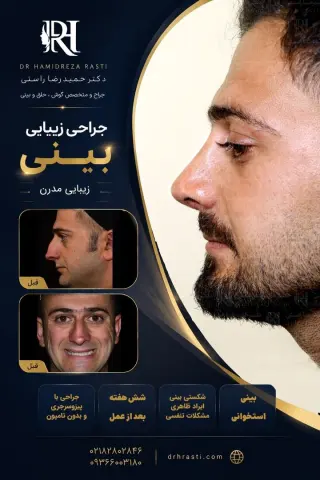 Real before-and-after result of Dr. Hamidreza Rasti's rhinoplasty