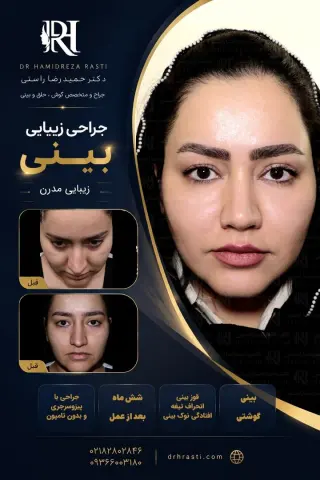 Real before-and-after result of Dr. Hamidreza Rasti's rhinoplasty