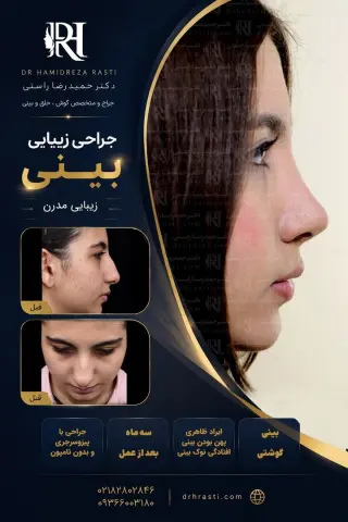 Real before-and-after result of Dr. Hamidreza Rasti's rhinoplasty