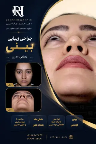 Real before-and-after result of Dr. Hamidreza Rasti's rhinoplasty