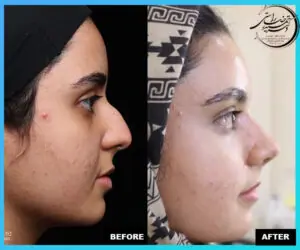 عوارض جراحی بینی در پیری + 3 راه حل 14 3