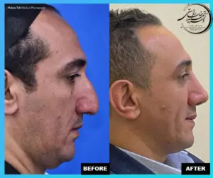 عوارض جراحی بینی در پیری + 3 راه حل 13 77