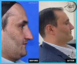 عوارض جراحی بینی در پیری + 3 راه حل 12 99