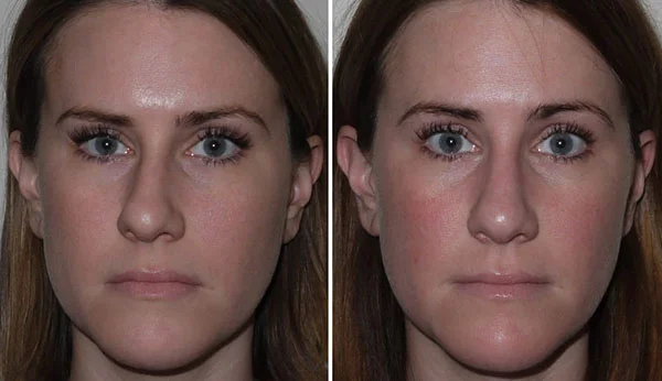 عمل سپتوپلاستی بینی چیست؟