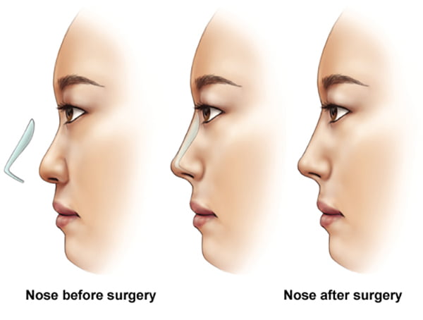 How to have a good nose job?