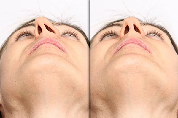 عمل سپتوپلاستی بینی چیست؟