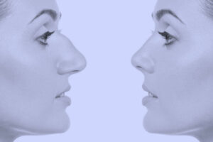 Complications of nose surgery in old age