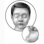 کیست بینی چیست