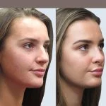 بهترین جراح بینی گوشتی در تهران