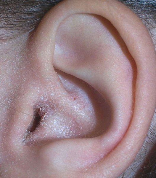 بیماری اگزمای گوش