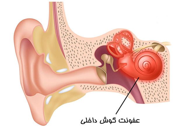 عفونت گوش - علائم و درمان