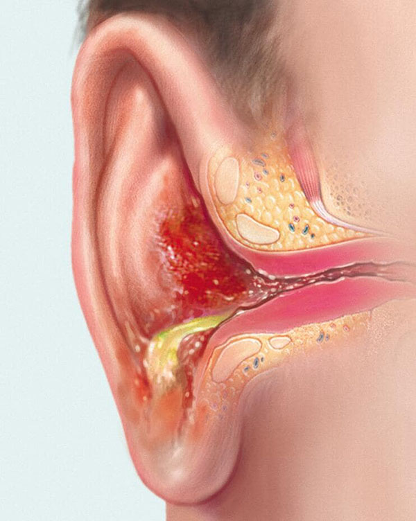 چه چیزی باعث چرک گوش می شود؟