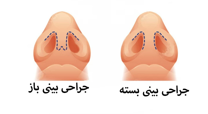 جراحی بینی باز: همه آنچه باید بدانید