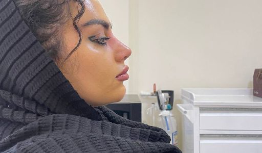 بینی استخوانی 1