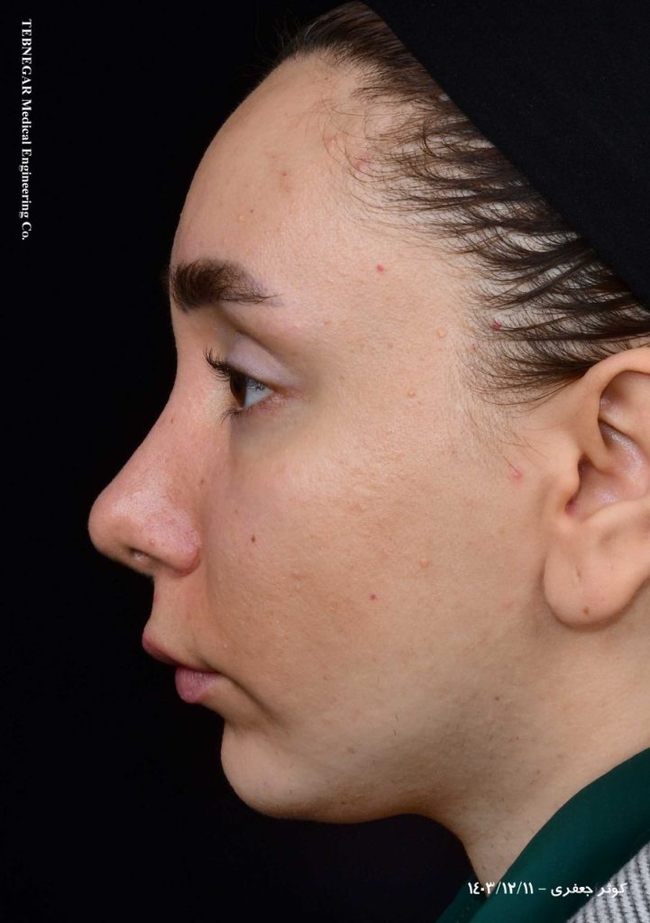 پروتز یا فیلر