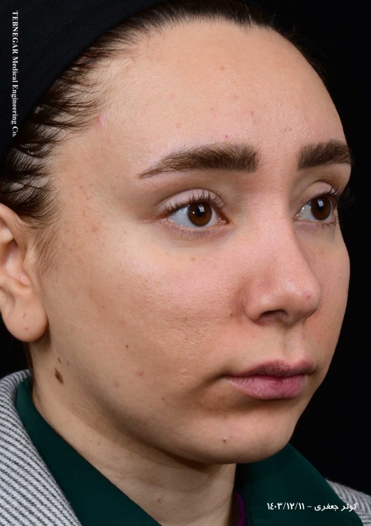 پروتز چانه دکتر راستی