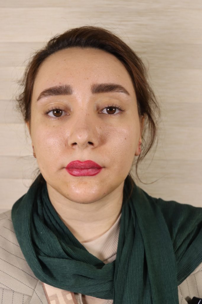 جراحی پروتز چانه