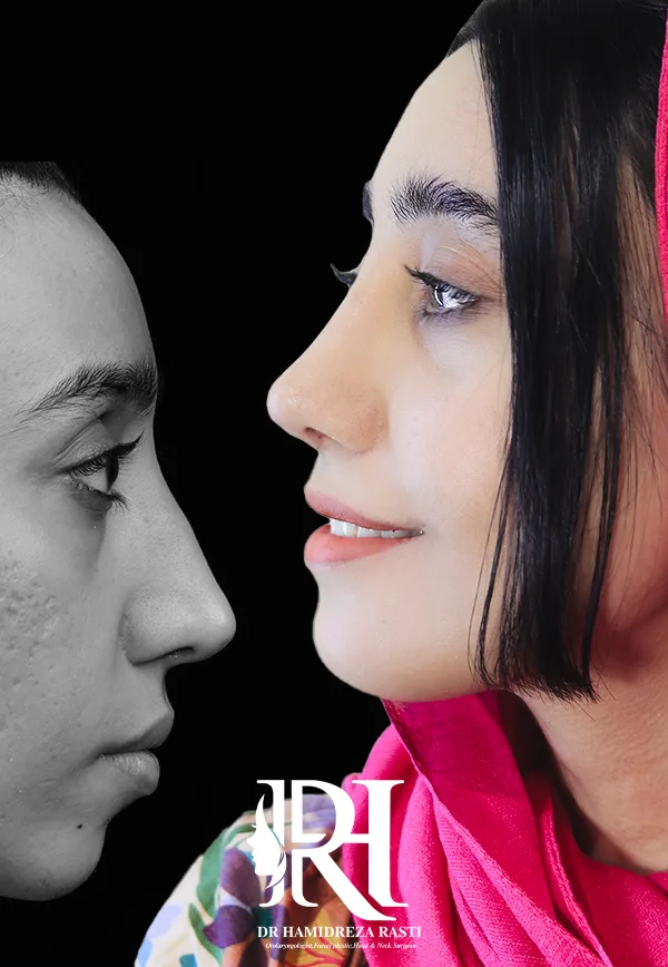 جراحی بینی ترمیمی