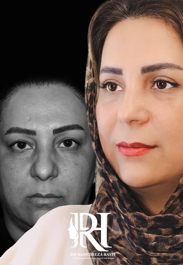 بلفاروپلاستی